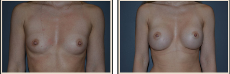 Breast Augmentation Before & After Results