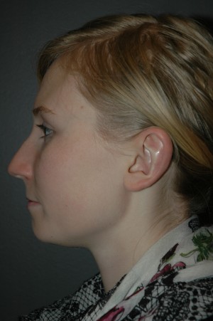 Otoplasty (Ear Surgery)