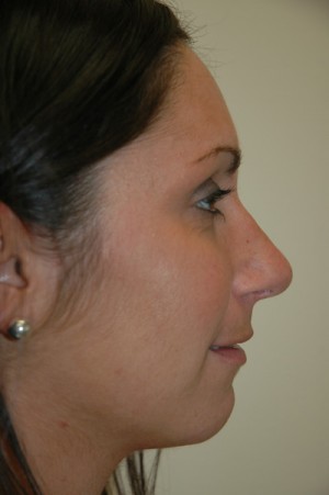 Rhinoplasty (Nose Surgery)