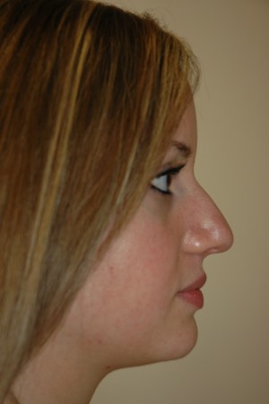 Rhinoplasty (Nose Surgery)
