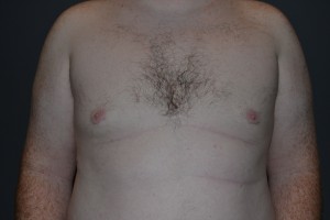 Gynecomastia (Male Breast Reduction)