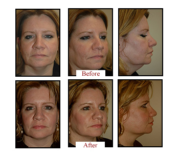 Doctor Bartlett - Facelift Before & Afters