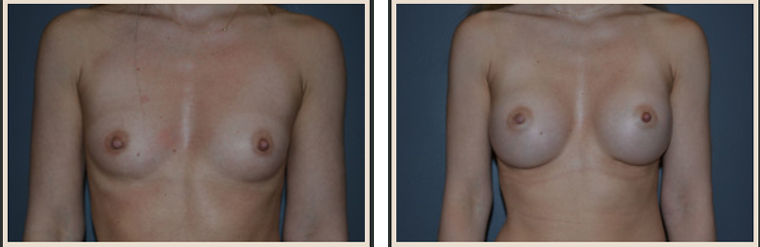 Breast Augmentation Before & After Results