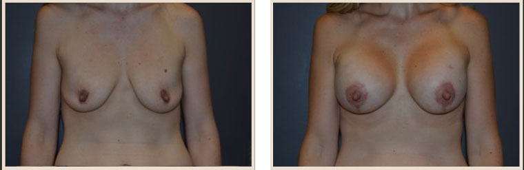 Breast Lift Before & After Results