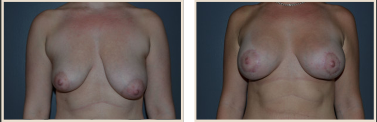 Breast Asymmetry Before & After Results