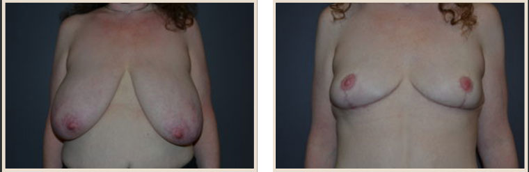Breast Reduction Before & After Results