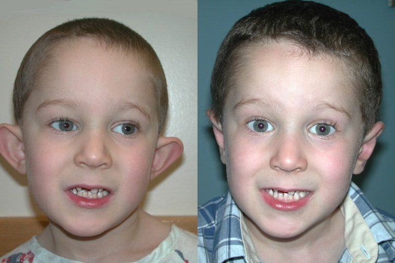 Otoplasty (Ear Surgery) before and after photo by Dr. Richard A. Bartlett in Brookline, MA