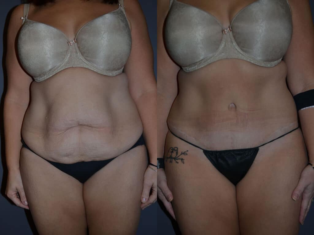 Abdominoplasty (Tummy Tuck) before and after photo by Dr. Richard A. Bartlett in Brookline, MA