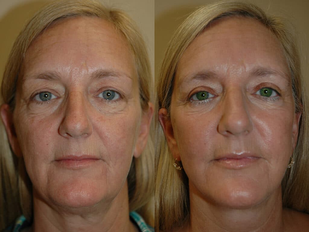 Blepharoplasty (Eyelid Surgery) before and after photo by Dr. Richard A. Bartlett in Brookline, MA