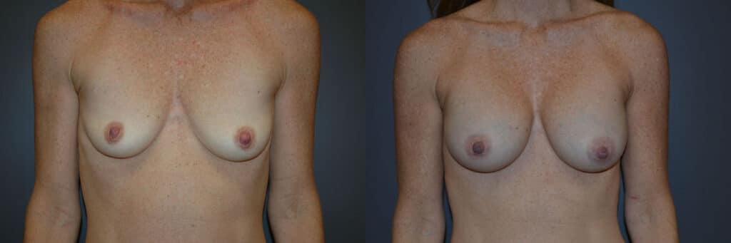 Breast Augmentation before and after photo by Dr. Richard A. Bartlett in Brookline, MA