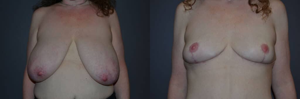 Breast Reduction before and after photo by Dr. Richard A. Bartlett in Brookline, MA