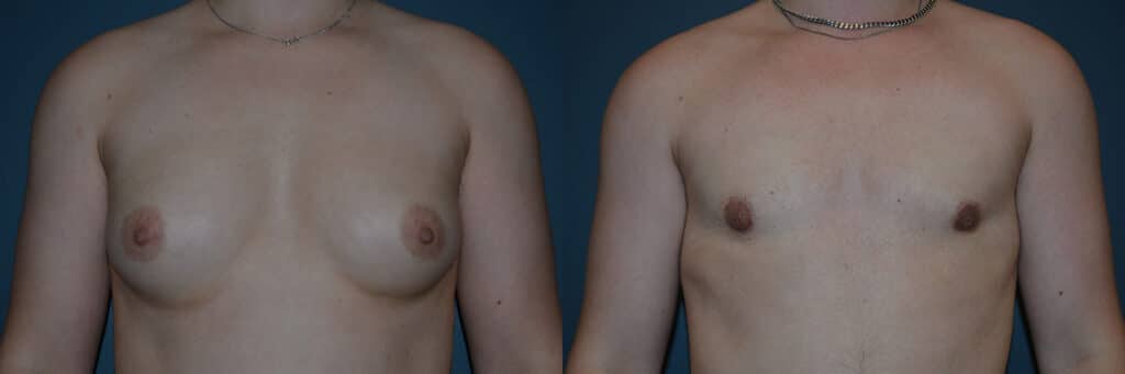 Gender Affirming Surgery before and after photo by Dr. Richard A. Bartlett in Brookline, MA