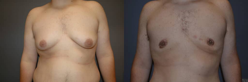 Gynecomastia (Male Breast Reduction) before and after photo by Dr. Richard A. Bartlett in Brookline, MA