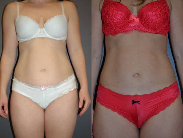 Liposuction before and after photo by Dr. Richard A. Bartlett in Brookline, MA