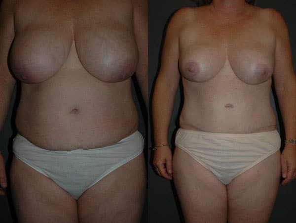 Abdominoplasty (Tummy Tuck) before and after photo by Dr. Richard A. Bartlett in Brookline, MA