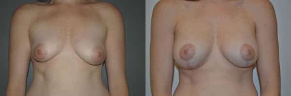 Breast Asymmetry before and after photo by Dr. Richard A. Bartlett in Brookline, MA