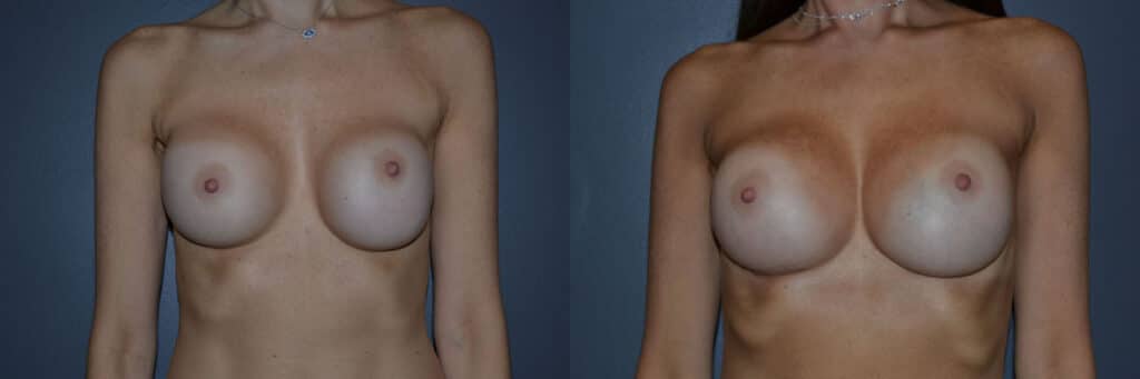 Breast Augmentation before and after photo by Dr. Richard A. Bartlett in Brookline, MA