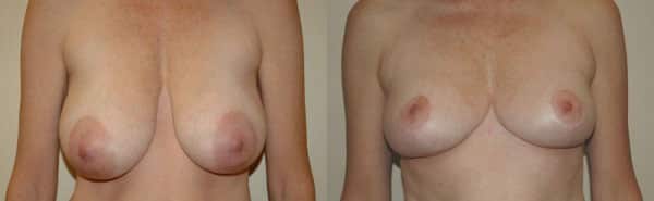 Breast Reduction before and after photo by Dr. Richard A. Bartlett in Brookline, MA