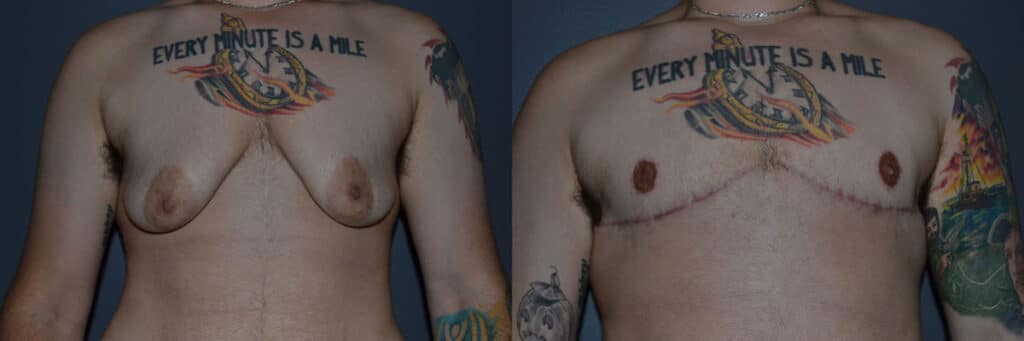 Gender Affirming Surgery before and after photo by Dr. Richard A. Bartlett in Brookline, MA