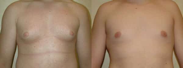 Gynecomastia (Male Breast Reduction) before and after photo by Dr. Richard A. Bartlett in Brookline, MA