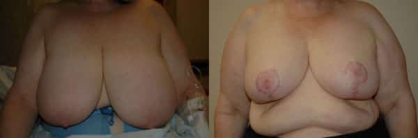 Breast Reduction before and after photo by Dr. Richard A. Bartlett in Brookline, MA