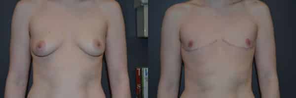 Gender Affirming Surgery before and after photo by Dr. Richard A. Bartlett in Brookline, MA