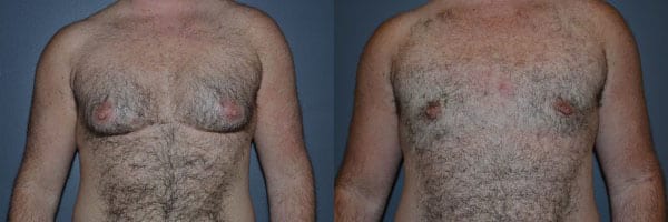 Gender Affirming Surgery before and after photo by Dr. Richard A. Bartlett in Brookline, MA