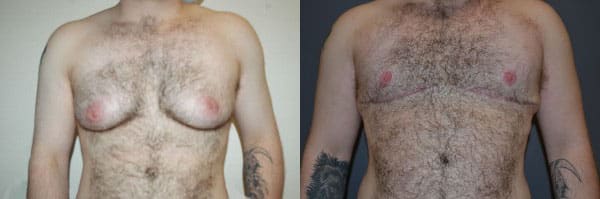 Gender Affirming Surgery before and after photo by Dr. Richard A. Bartlett in Brookline, MA
