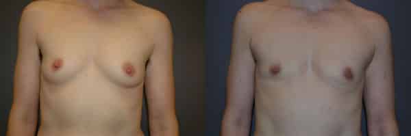 Gender Affirming Surgery before and after photo by Dr. Richard A. Bartlett in Brookline, MA