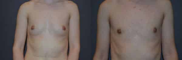 Gender Affirming Surgery before and after photo by Dr. Richard A. Bartlett in Brookline, MA