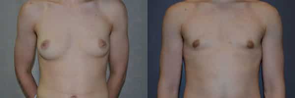Gender Affirming Surgery before and after photo by Dr. Richard A. Bartlett in Brookline, MA