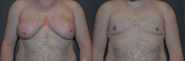 Gender Affirming Surgery before and after photo by Dr. Richard A. Bartlett in Brookline, MA