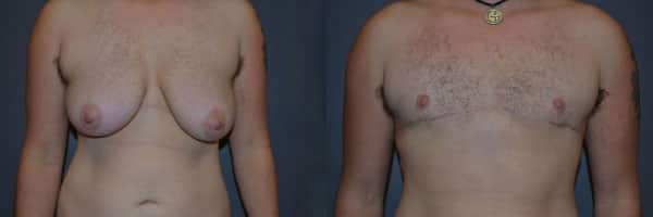 Gender Affirming Surgery before and after photo by Dr. Richard A. Bartlett in Brookline, MA