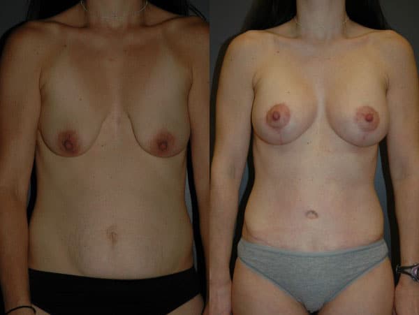 Abdominoplasty (Tummy Tuck) before and after photo by Dr. Richard A. Bartlett in Brookline, MA