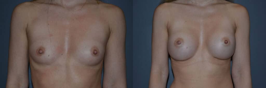 Breast Augmentation before and after photo by Dr. Richard A. Bartlett in Brookline, MA