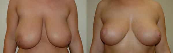 Breast Reduction before and after photo by Dr. Richard A. Bartlett in Brookline, MA
