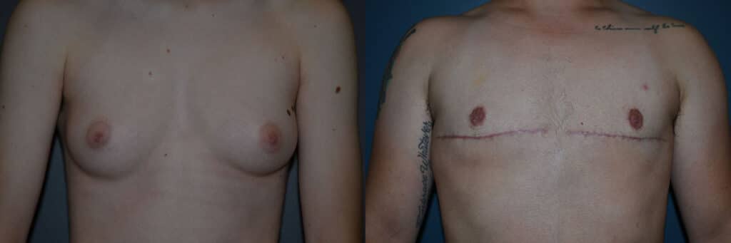 Gender Affirming Surgery before and after photo by Dr. Richard A. Bartlett in Brookline, MA