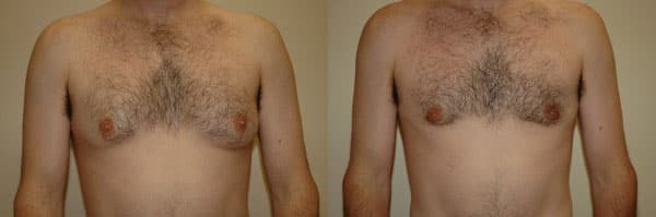 Gynecomastia (Male Breast Reduction) before and after photo by Dr. Richard A. Bartlett in Brookline, MA