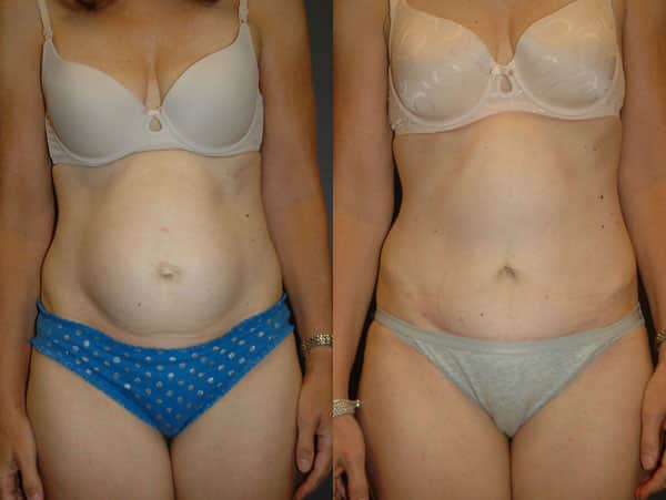 Abdominoplasty (Tummy Tuck) before and after photo by Dr. Richard A. Bartlett in Brookline, MA