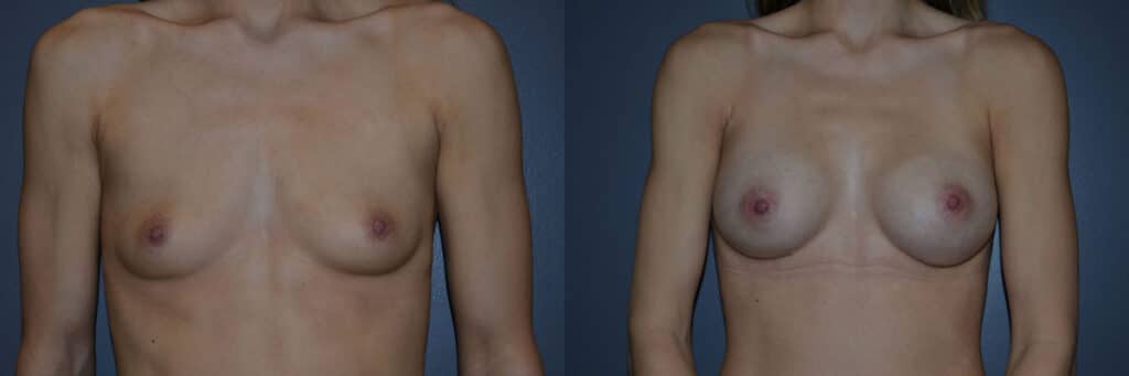 Breast Augmentation before and after photo by Dr. Richard A. Bartlett in Brookline, MA