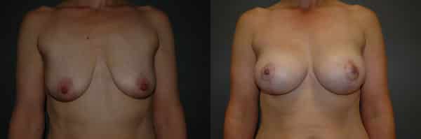 Breast Lift before and after photo by Dr. Richard A. Bartlett in Brookline, MA