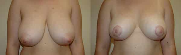 Breast Reduction before and after photo by Dr. Richard A. Bartlett in Brookline, MA
