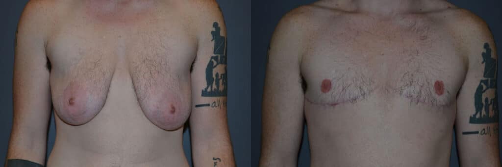 Gender Affirming Surgery before and after photo by Dr. Richard A. Bartlett in Brookline, MA