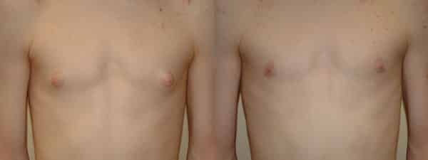 Gynecomastia (Male Breast Reduction) before and after photo by Dr. Richard A. Bartlett in Brookline, MA