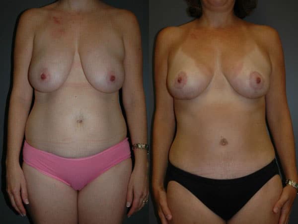 Abdominoplasty (Tummy Tuck) before and after photo by Dr. Richard A. Bartlett in Brookline, MA