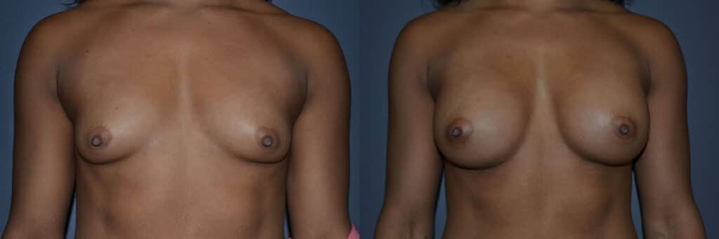 Breast Augmentation before and after photo by Dr. Richard A. Bartlett in Brookline, MA