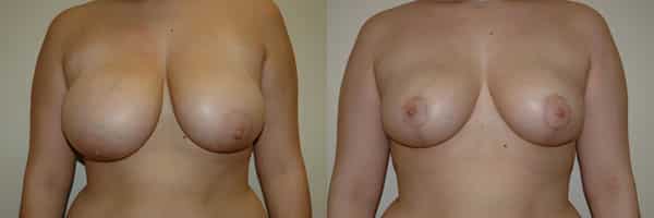 Breast Reduction before and after photo by Dr. Richard A. Bartlett in Brookline, MA
