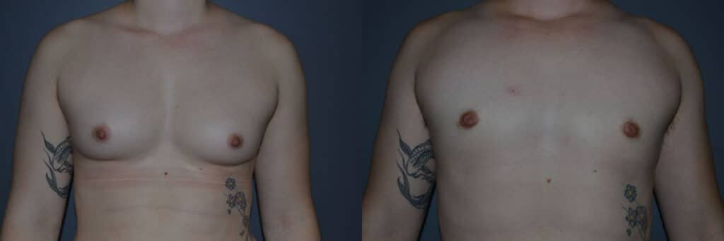 Gender Affirming Surgery before and after photo by Dr. Richard A. Bartlett in Brookline, MA