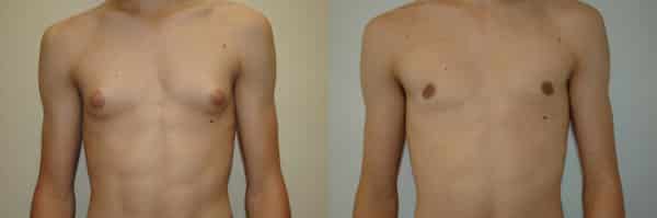 Gynecomastia (Male Breast Reduction) before and after photo by Dr. Richard A. Bartlett in Brookline, MA