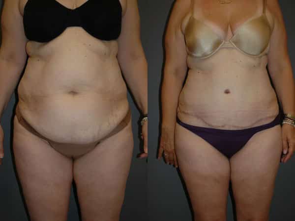 Abdominoplasty (Tummy Tuck) before and after photo by Dr. Richard A. Bartlett in Brookline, MA